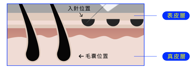 入針位置示意圖