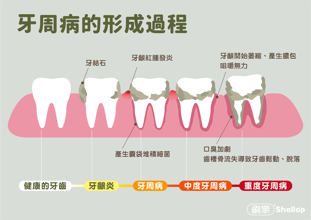 刷樂保健室 牙周病的發展過程