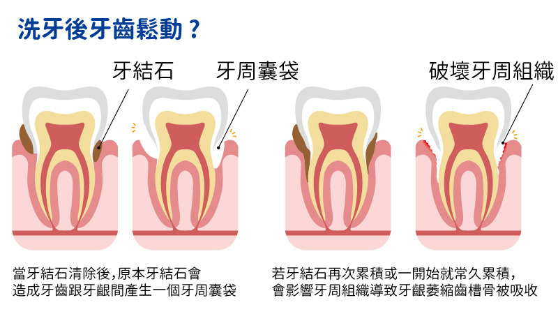 刷樂口腔保健室-洗牙後牙齒鬆動