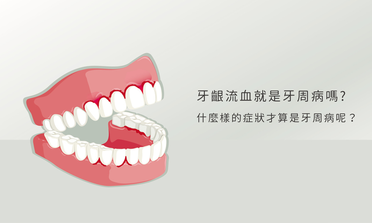 刷樂保健室 牙齦流血救是牙周病嗎?