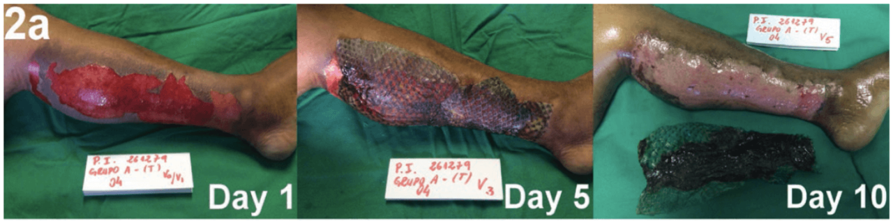 巴西醫療團隊使用鯛魚魚皮作為嚴重傷燙傷敷料，有效保濕、促進傷口修護、消炎止痛