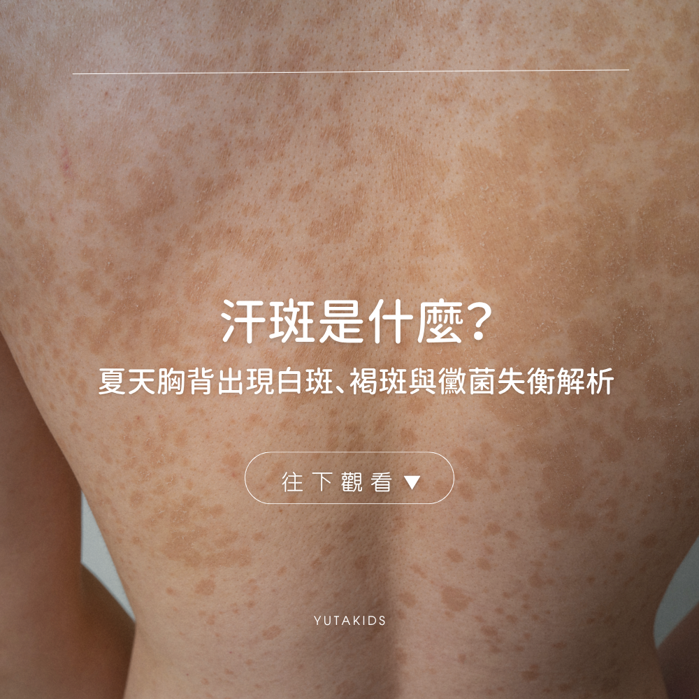 tinea-versicolor-summer-care