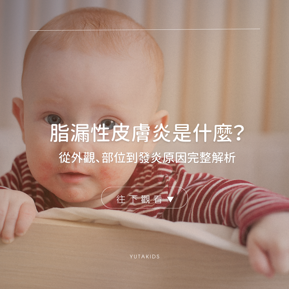 seborrheic-dermatitis-guide