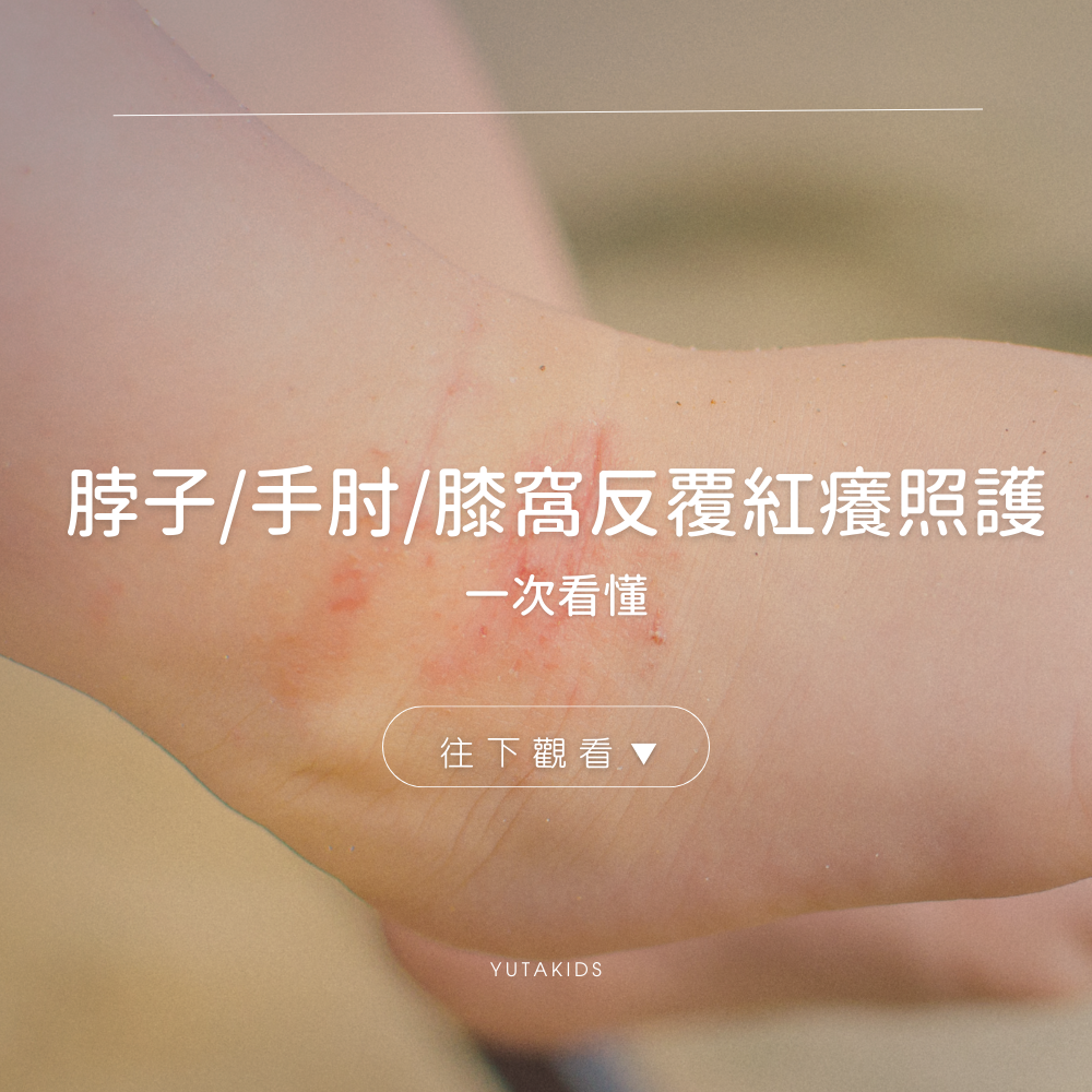 flexural-eczema-neck-elbow-knee-care