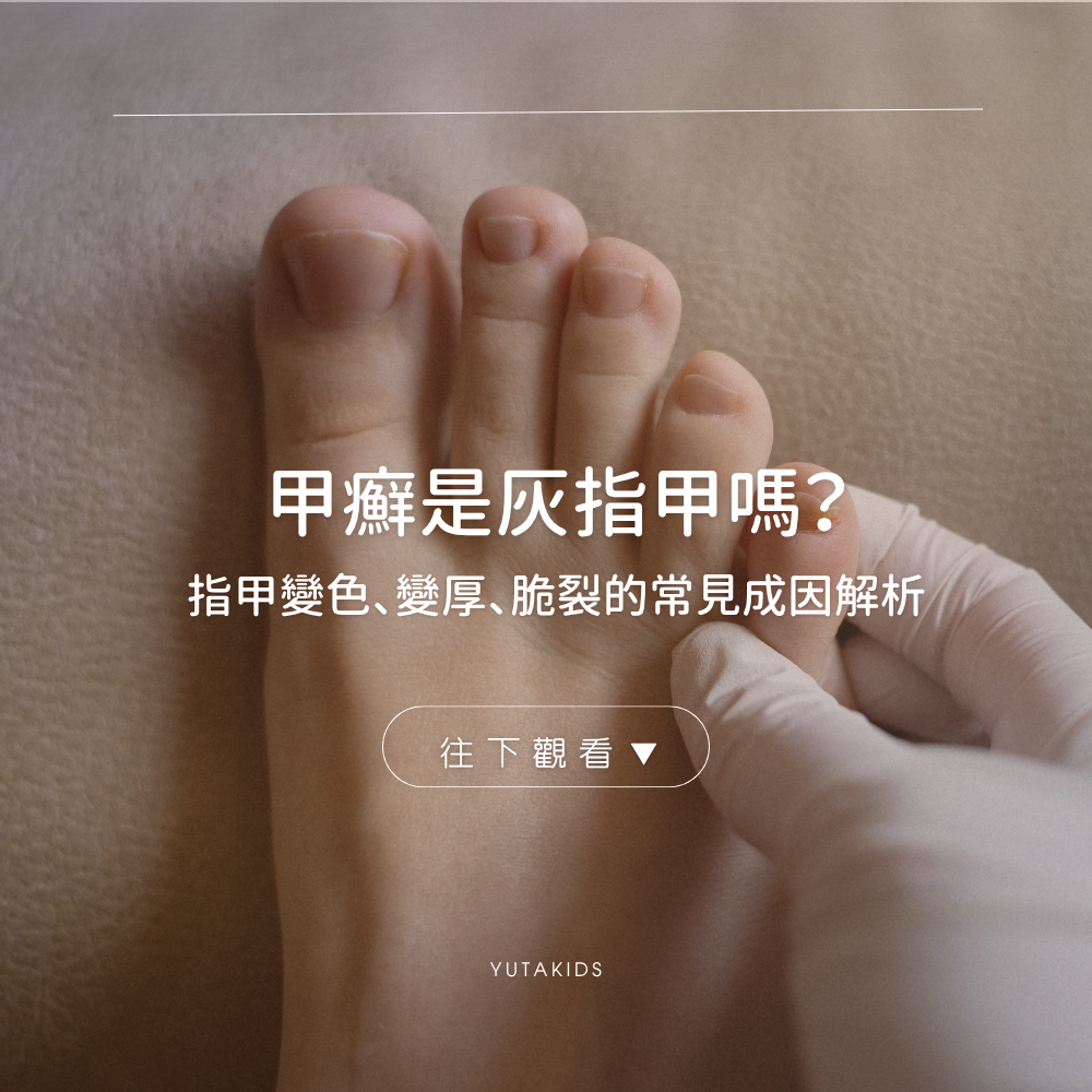 onychomycosis-gray-nail-causes-guide