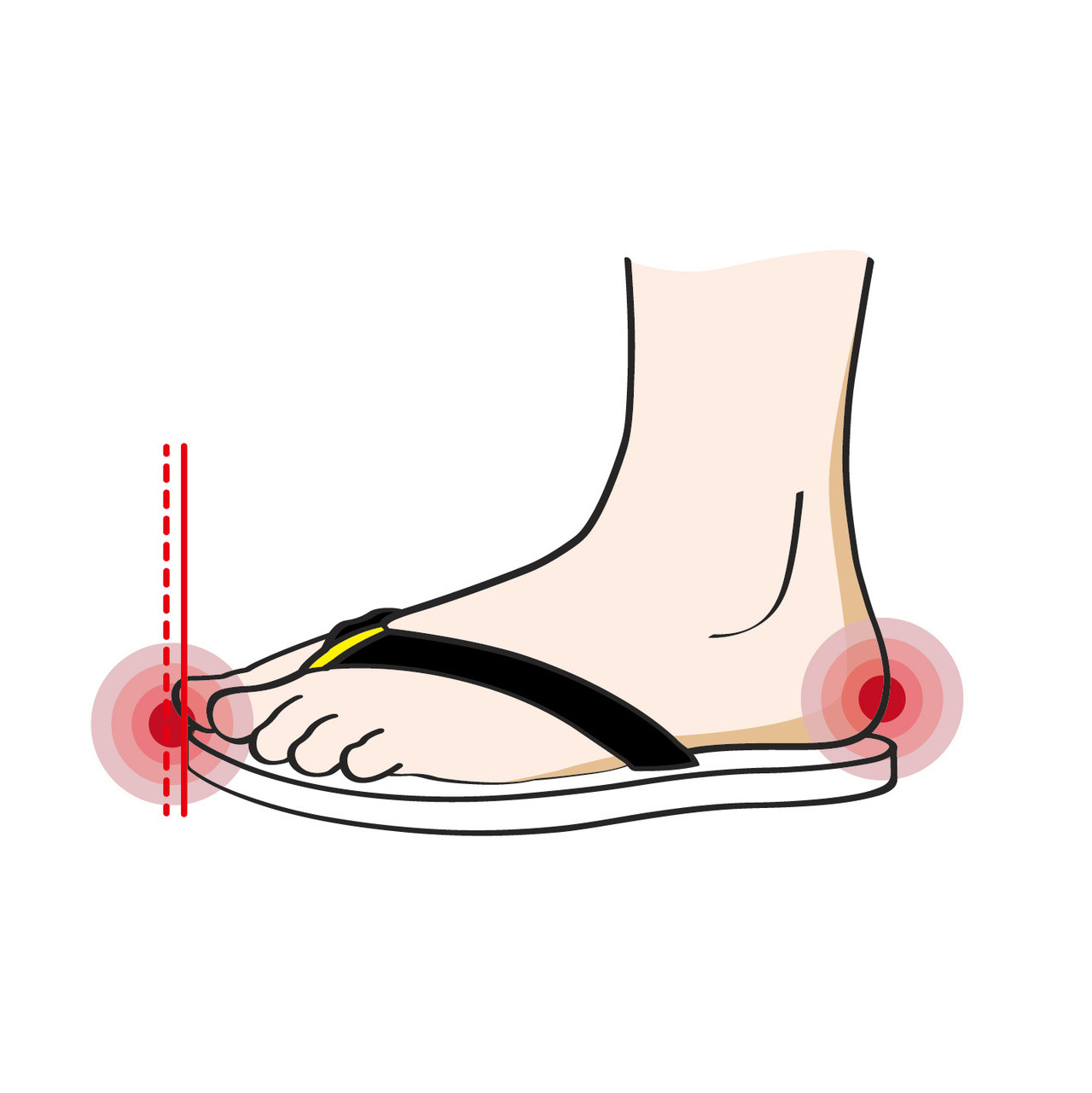 腳掌時常出現大大小小的傷口: 鞋子過短，容易直接碰撞足部