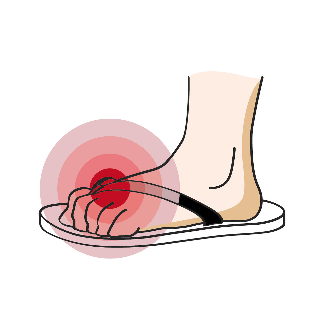 腳背被勒出痕跡好痛:鞋子太緊，走路的姿態也會變得緊繃，腳趾頭要一直出力「夾」住夾腳拖,鞋子太鬆，無法安穩套在腳上
